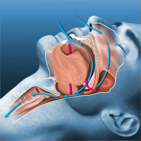 Sleep Apnea