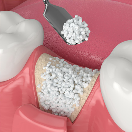 Bone Grafting