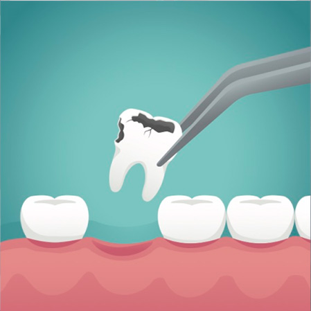 Tooth Extractions