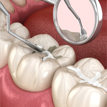 Composite Dental Fillings