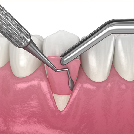 Soft Tissue Grafting