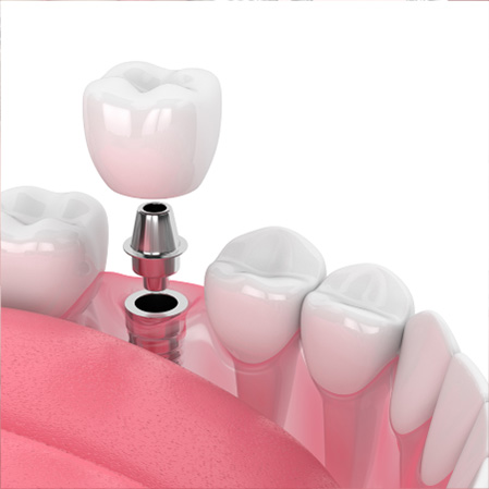 Dental Implants