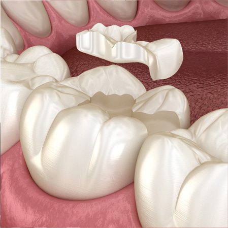 Dental Inlays & Onlays